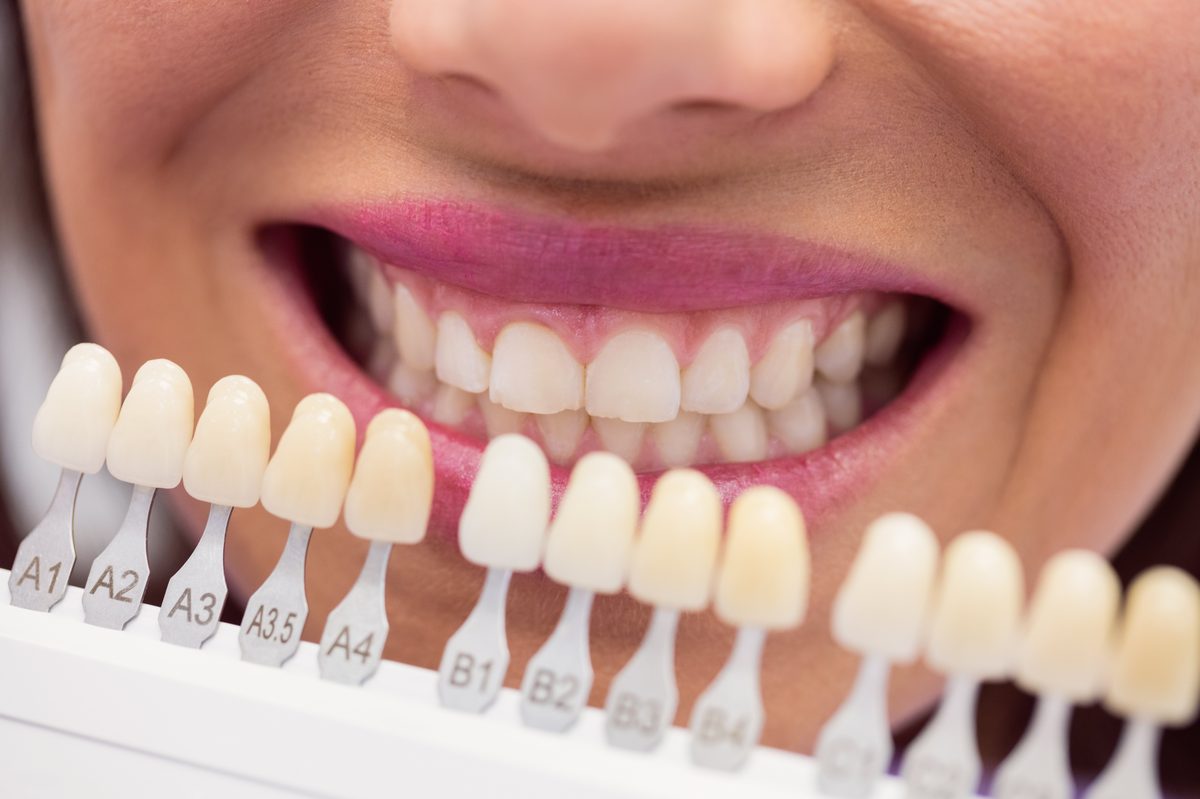 Smile Makeover (Orthodontic)