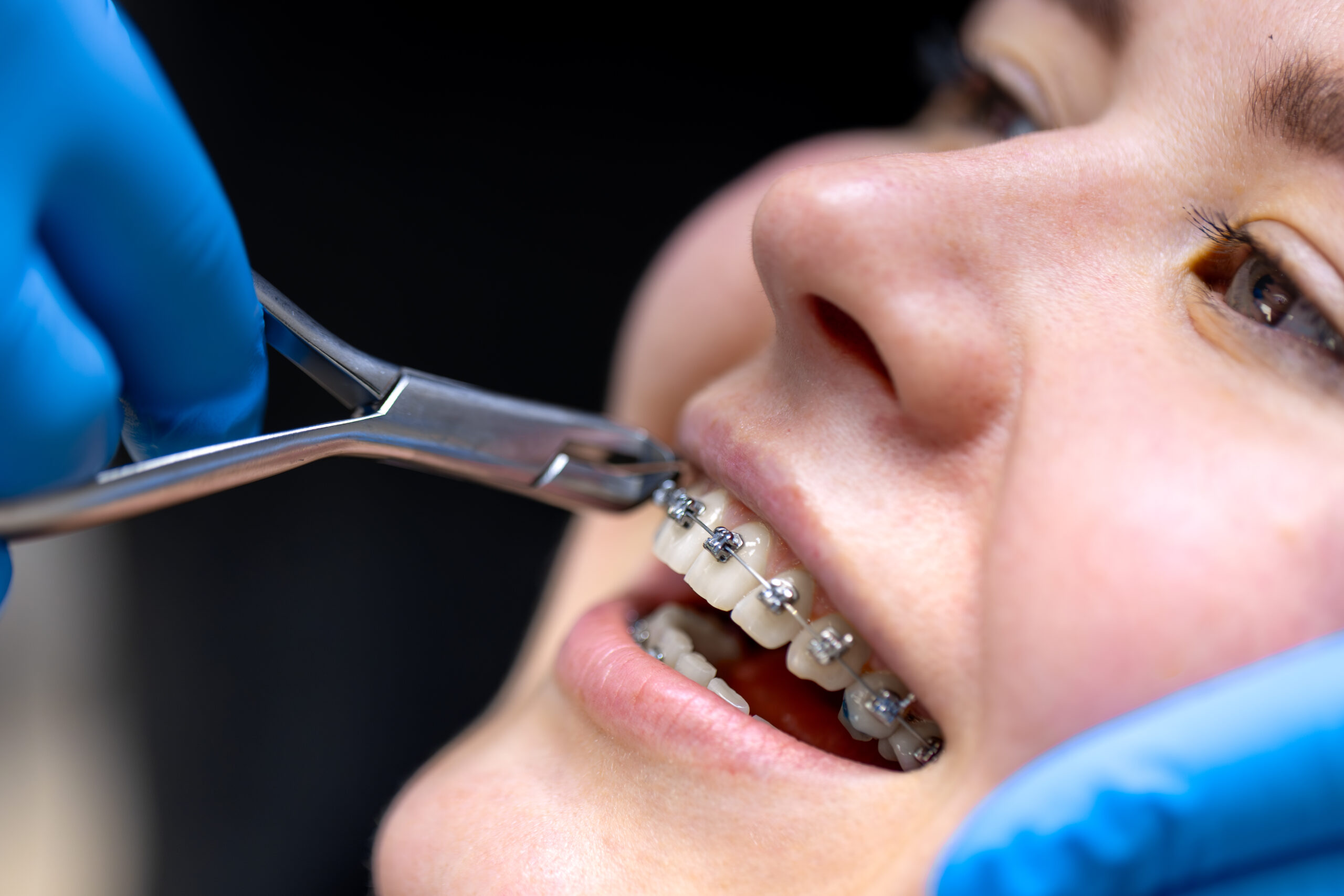 Teeth Alignment (Braces)